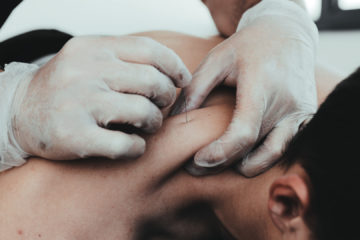 Dry needling